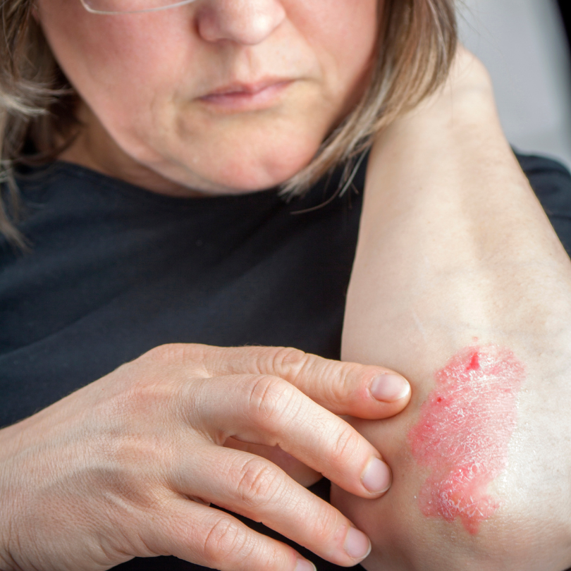 Eczema or Psoriasis? How to Tell the Difference