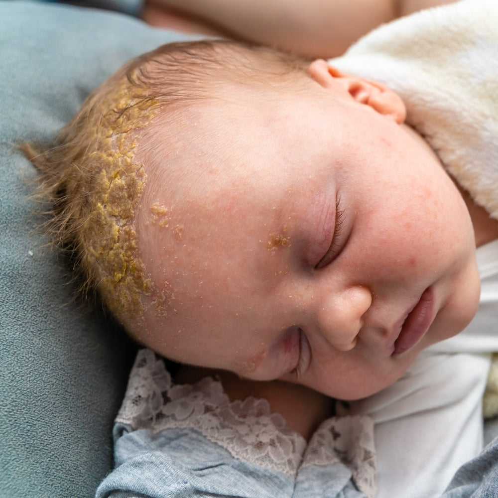 Cradle Cap Explained: The True Causes, Treatments & What to Avoid