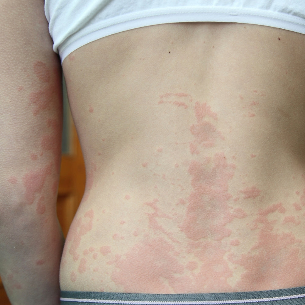 Hives or Eczema? Understanding the Difference